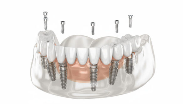 All on 6 – nowoczesna, stabilna i trwała odbudowa całego łuku zębowego